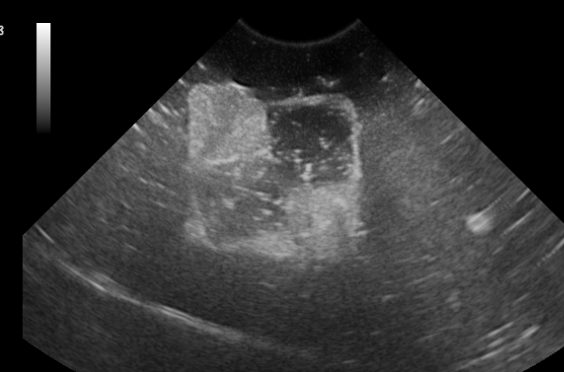 Formation ECHOINT1 : Echographie: ponctions, biopsies, pr&eacute;l&egrave;vements &eacute;choguid&eacute;s /TP sur fant&ocirc;mes