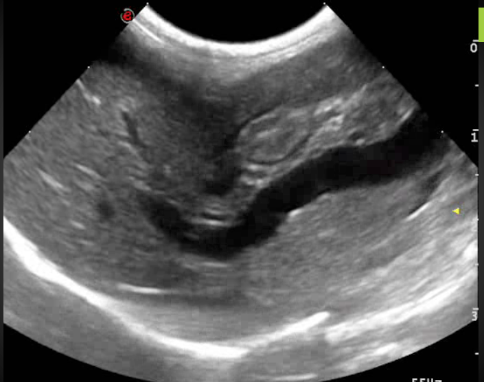 Formation EAN1 : Echographie abdominale normale : Partie 1 - foie, rate, reins, vessie, appareil g&eacute;nital.