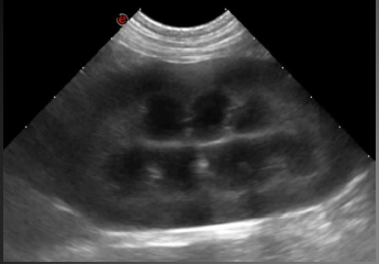 Formation EAN1 : Echographie abdominale normale : Partie 1 - foie, rate, reins, vessie, appareil g&eacute;nital.
