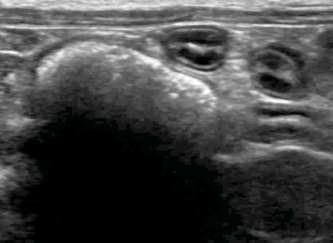 Formation EAN2 : Echographie abdominale normale : Partie 2 - surr&eacute;nales, noeuds lymphatiques, tube digestif, pancr&eacute;as, vascularisation.