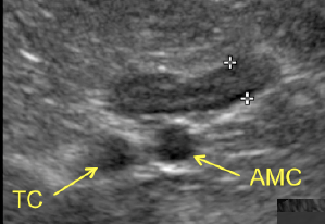 Formation EAN2 : Echographie abdominale normale : Partie 2 - surr&eacute;nales, noeuds lymphatiques, tube digestif, pancr&eacute;as, vascularisation.