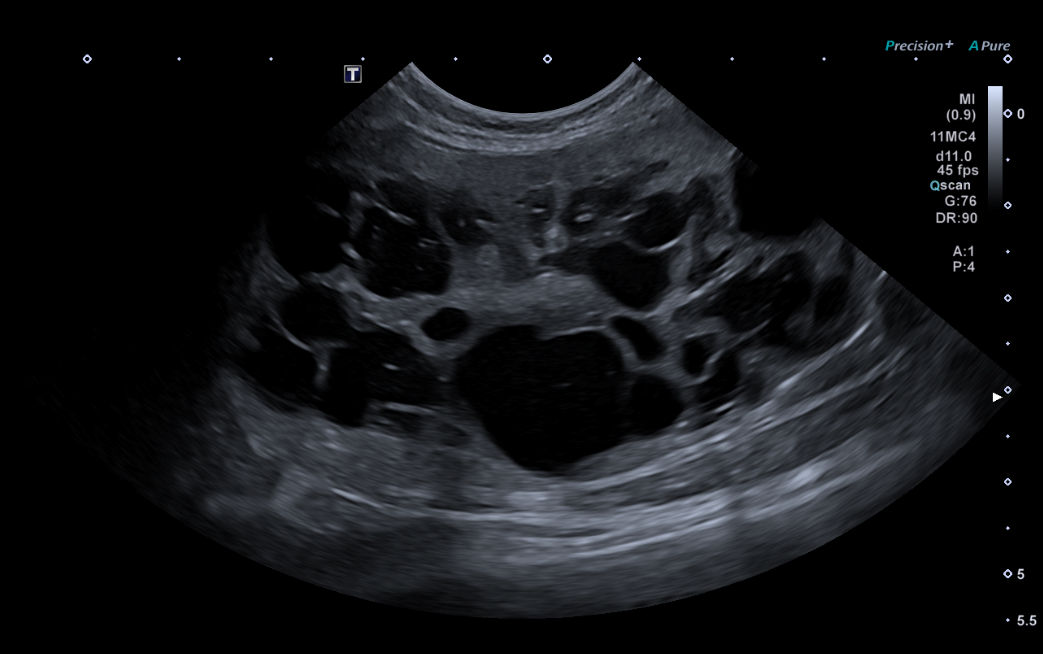 Formation EAP2-LIVE : Echographie abdominale pathologique: Appareil urinaire et g&eacute;nital