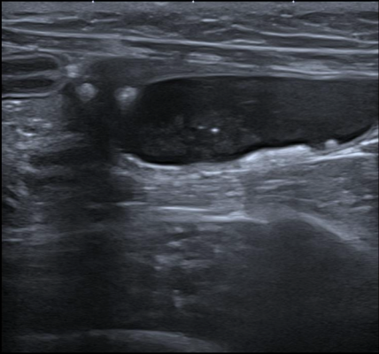 Formation EAP2 : Echographie abdominale pathologique - appareil urinaire, appareil g&eacute;nital