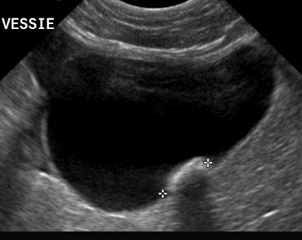 Formation EAP2 : Echographie abdominale pathologique - appareil urinaire, appareil g&eacute;nital