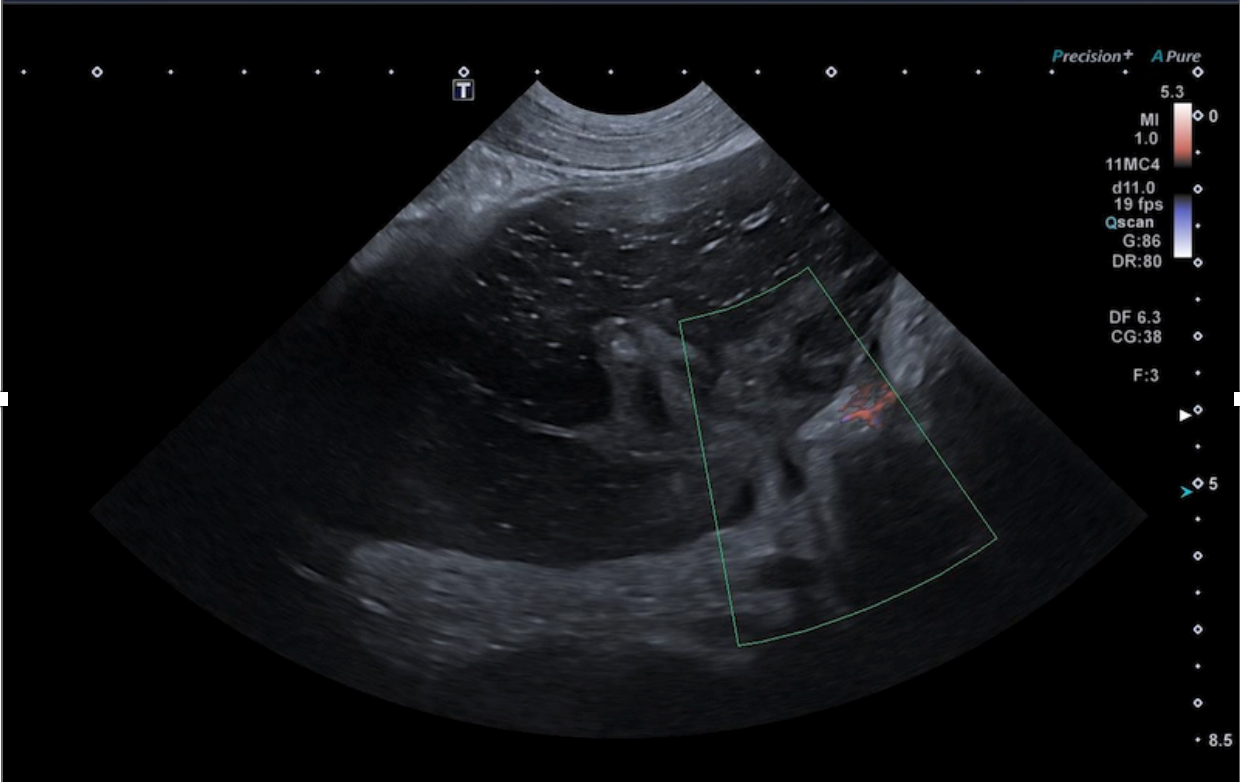 Formation EAP3 : Echographie abdominale pathologique : Tube digestif, pancr&eacute;as et surr&eacute;nales