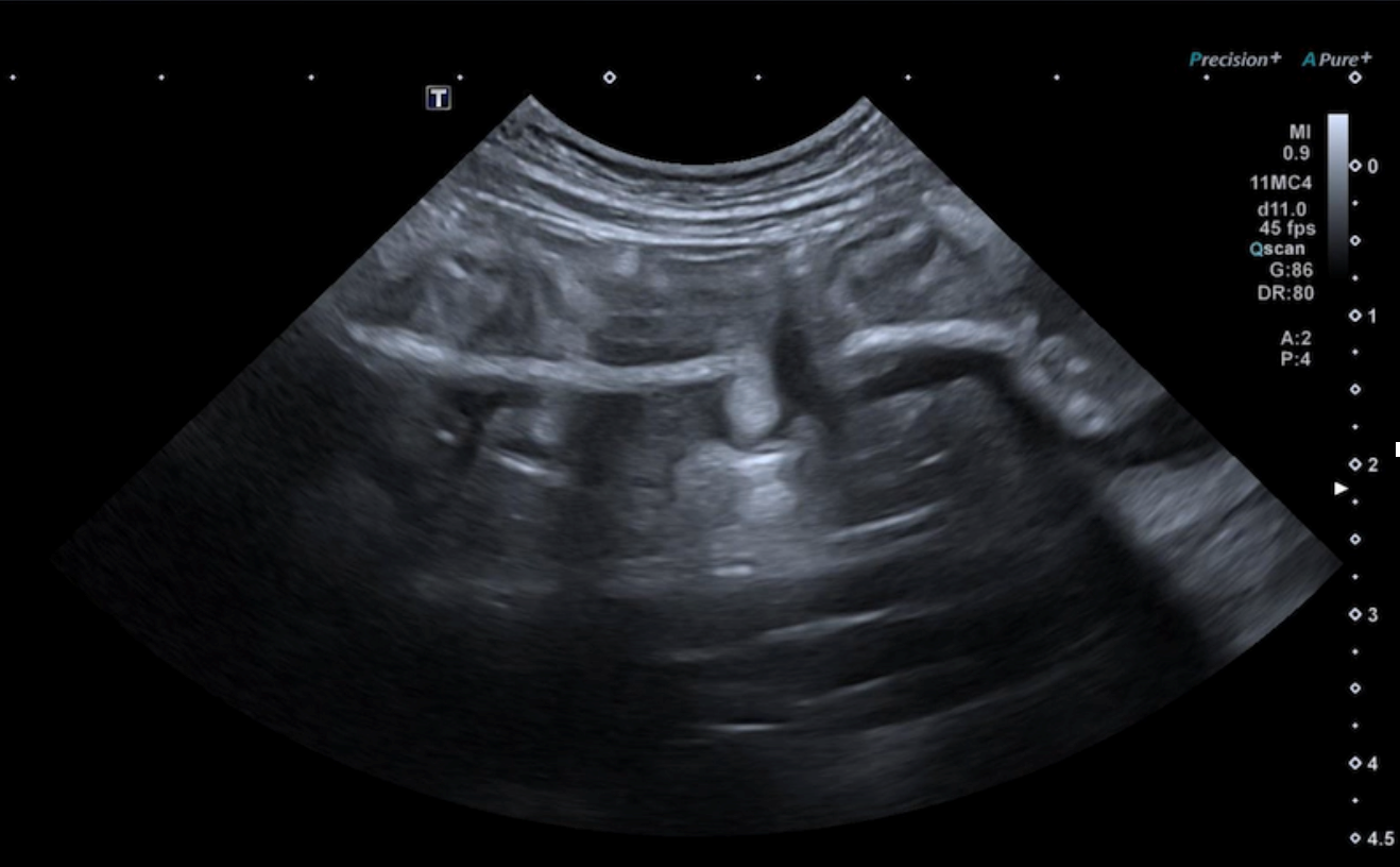 Formation EAP3 : Echographie abdominale pathologique : Tube digestif, pancr&eacute;as et surr&eacute;nales