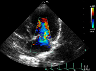 Formation EC003B : Echographie Doppler cardiaque : aspect normal