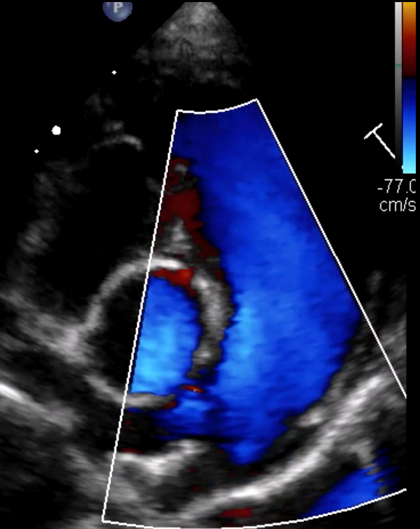 Formation EC0010 : Perfectionner ma pratique en &eacute;chocardiographie au quotidien &agrave; travers des cas cliniques. Partie 2.