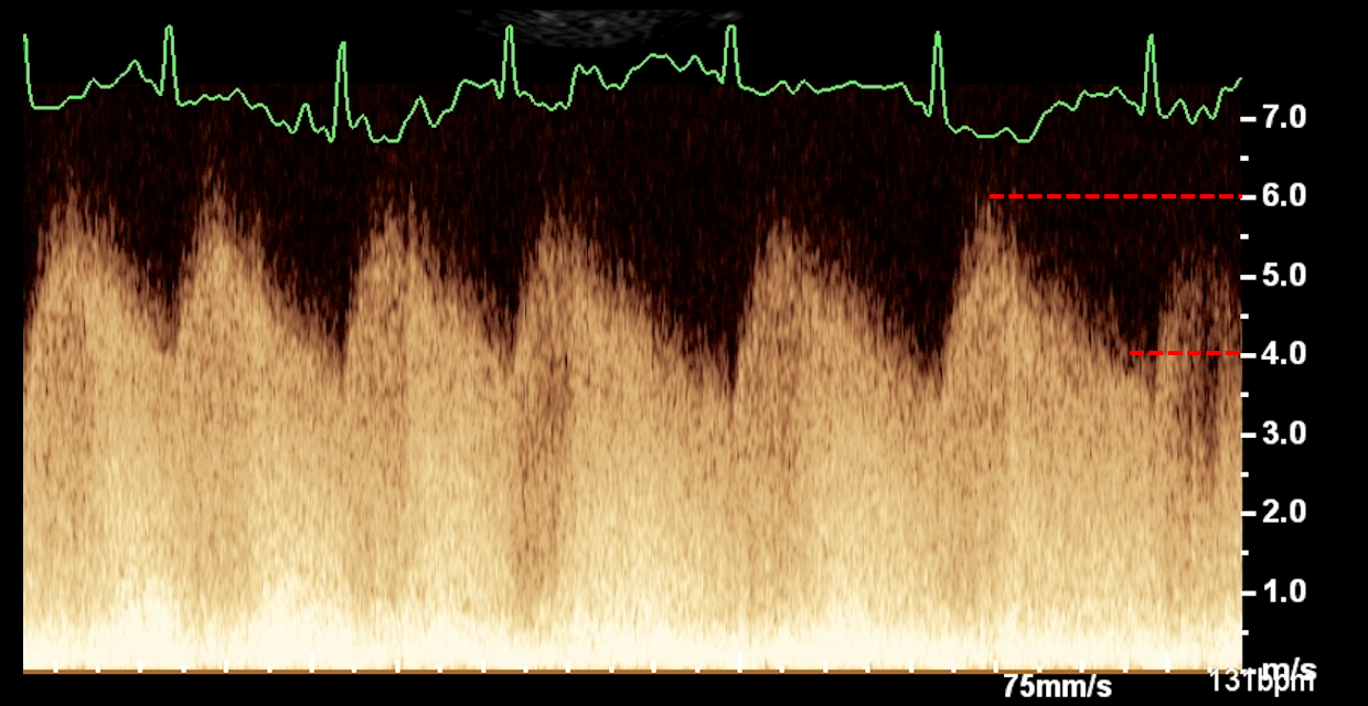 Formation EC0010 : Perfectionner ma pratique en &eacute;chocardiographie au quotidien &agrave; travers des cas cliniques. Partie 2.