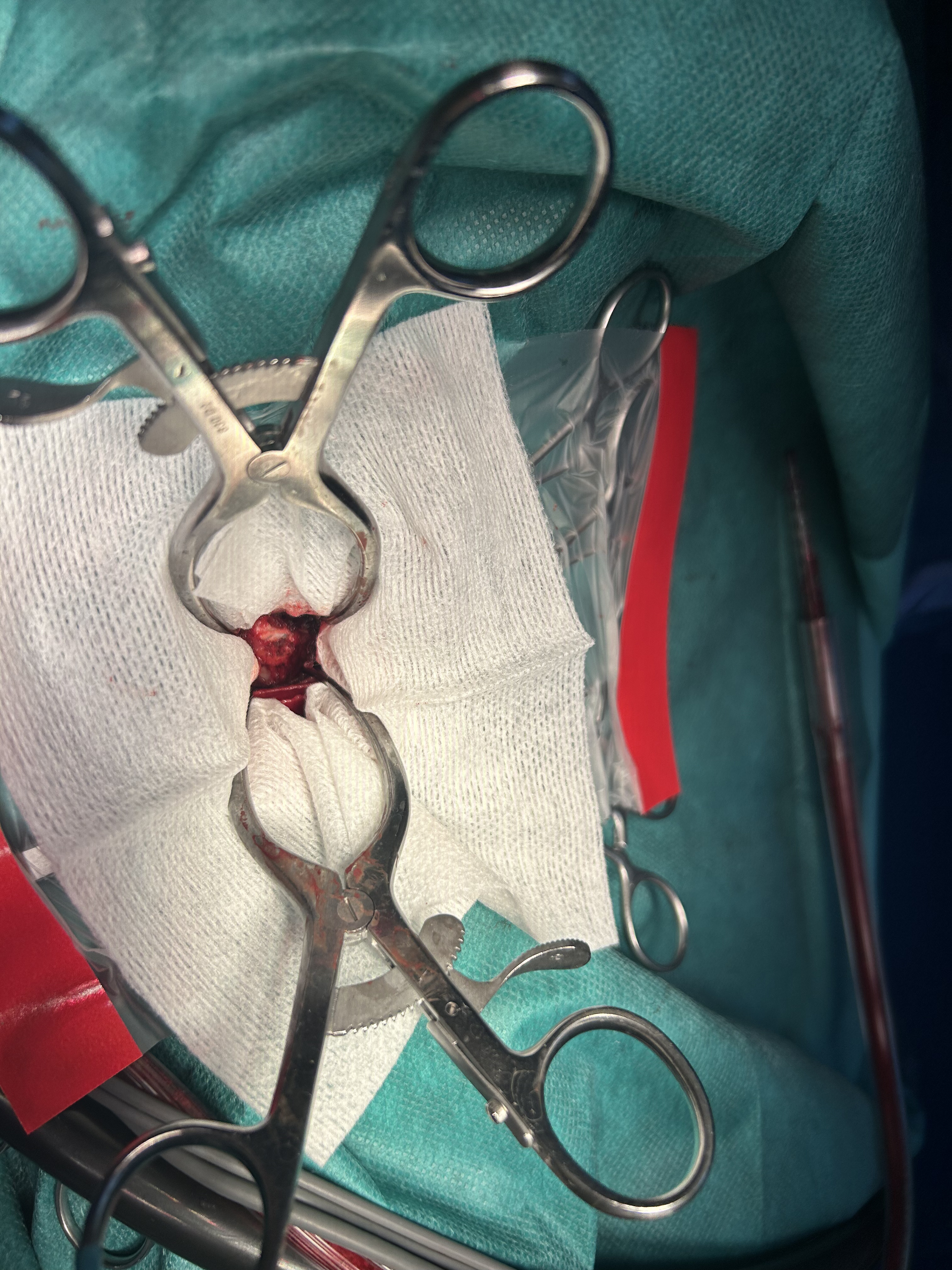 Formation NCHIR2-B : Neurochirurgie avanc&eacute;e : corpectomie cervicale et introduction &agrave; la stabilisation