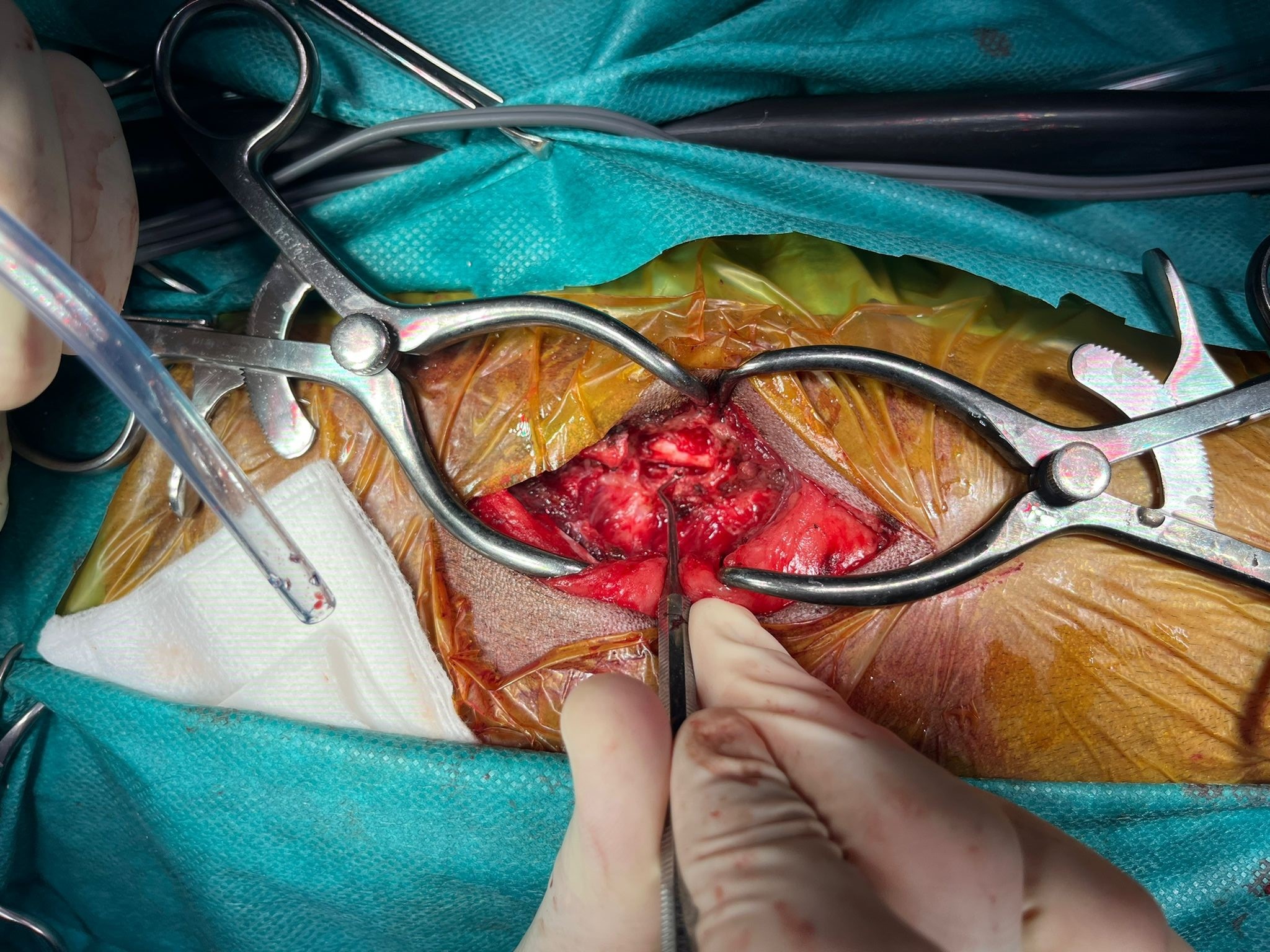 Formation NCHIR1 : Neurochirurgie de base : h&eacute;milaminectomie thoracolombaire et alternatives