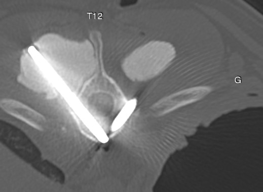 Formation NCHIR2-B : Neurochirurgie avanc&eacute;e : corpectomie cervicale et introduction &agrave; la stabilisation