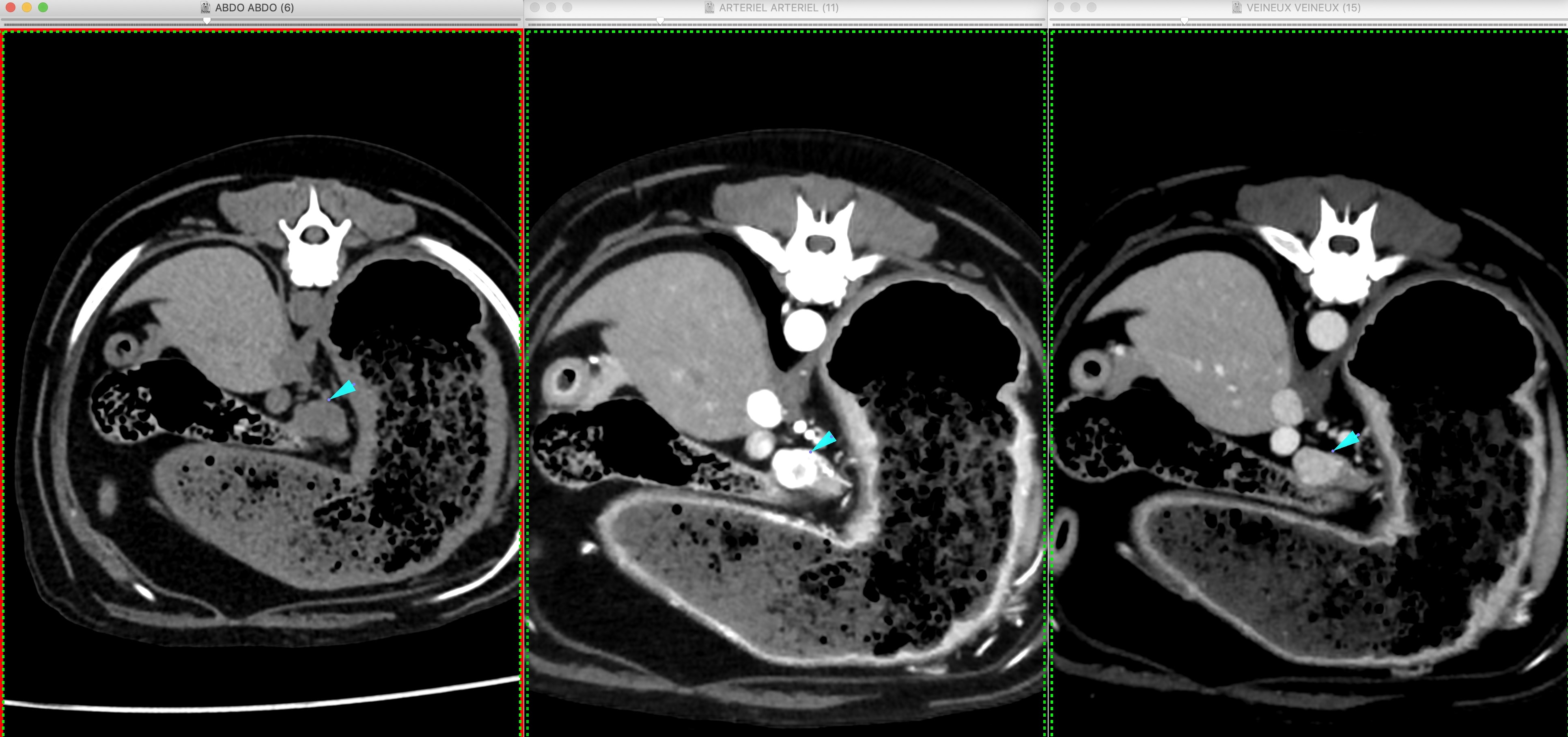 Formation SCANB : Module Scanner: Niveau 2: Vasculaire thoracique et abdominal, tube digestif, surr&eacute;nales, affections naso-sinusales, c&eacute;rebrales...